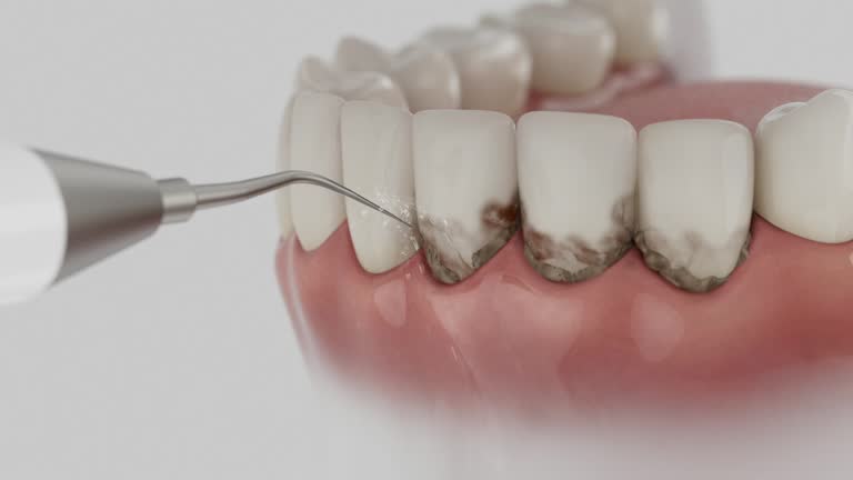 Trusted Wisdom Tooth Removal service in Hales Corners, WI - Dentist Open Now
